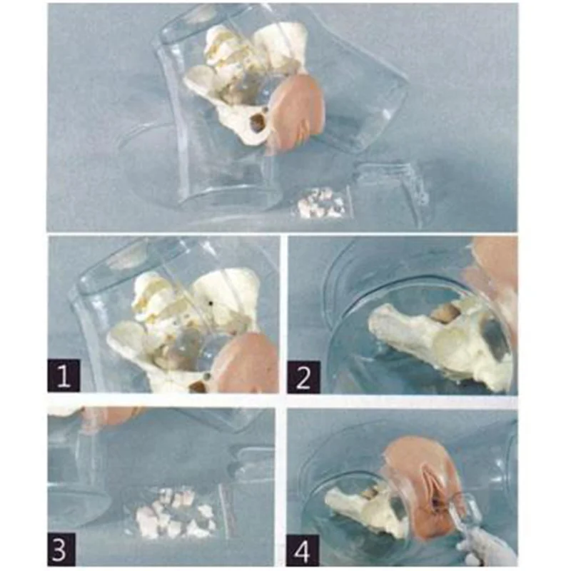 T32 Transparent Curettage Model