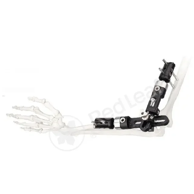 3D printed talus prosthesis (Custom)